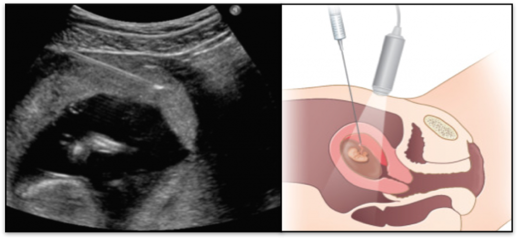 Amniocentesis in Pune